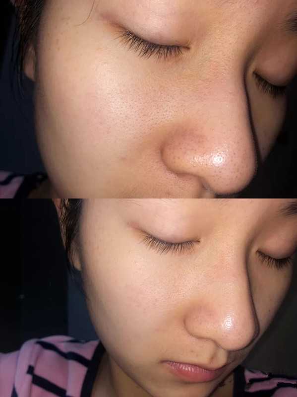 有哪些可以改善鼻翼两侧毛孔粗大和黑头现象的方法 知乎