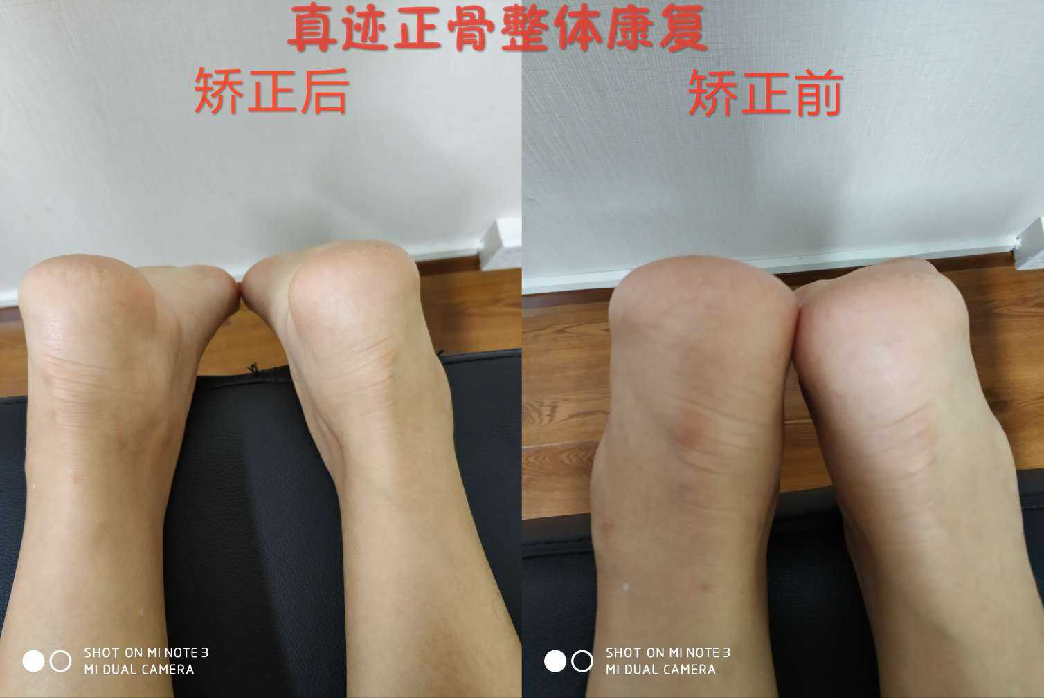 这段时间处理的长短腿和脊柱侧弯的案例,… - 知乎