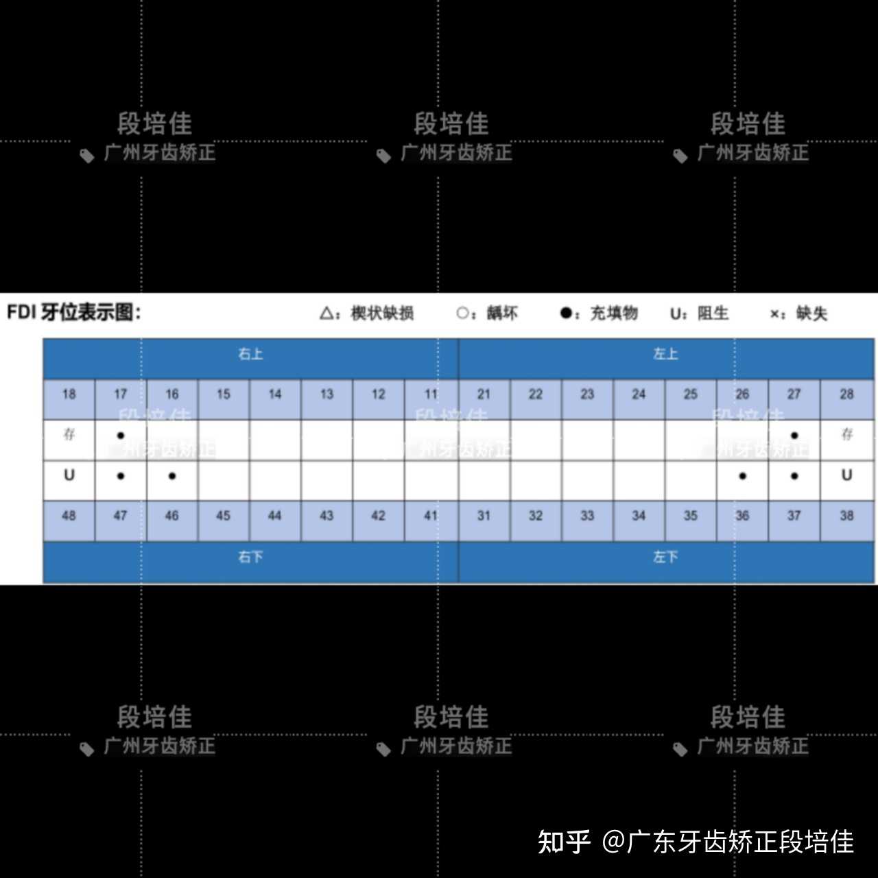 广东牙齿矫正段培佳 的想法 一位面部轻度不对称,自诉牙齿不美观想要