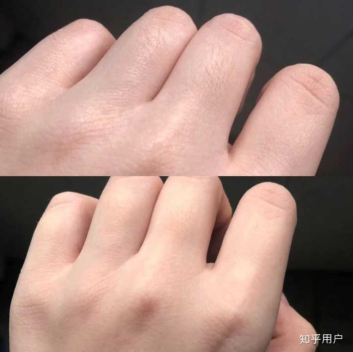腋毛拔完有鸡皮疙瘩(腋下脱毛后有鸡皮疙瘩)