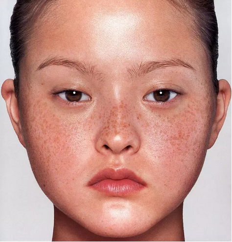 为什么中国女性容易长色斑?