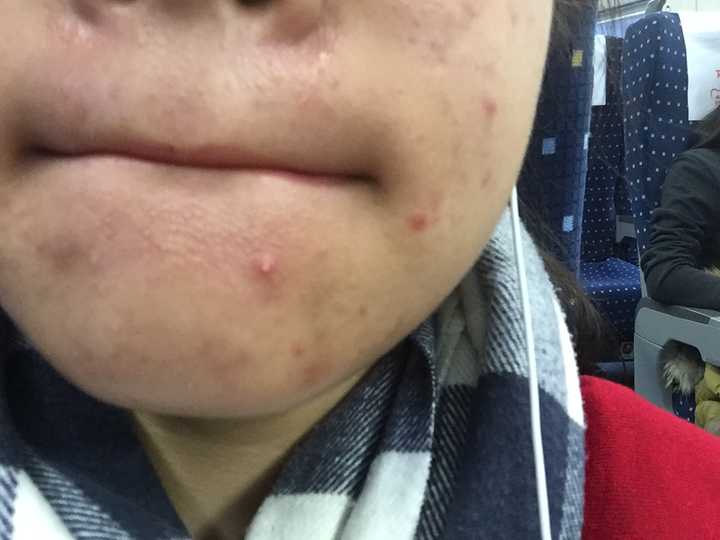 毛孔堵塞长闭口 怎样疏通 知乎