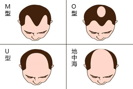 脱发形状不一,但最典型的数这集中:m型脱发,o型脱发,u型脱发和「地