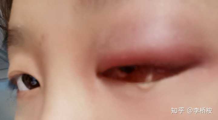 一只眼睛上眼皮和眼角突然肿了这是为什么 李桥桉的回答 知乎 一只眼睛上眼皮和眼角突然肿了这是为什么 李桥桉的回答 知乎