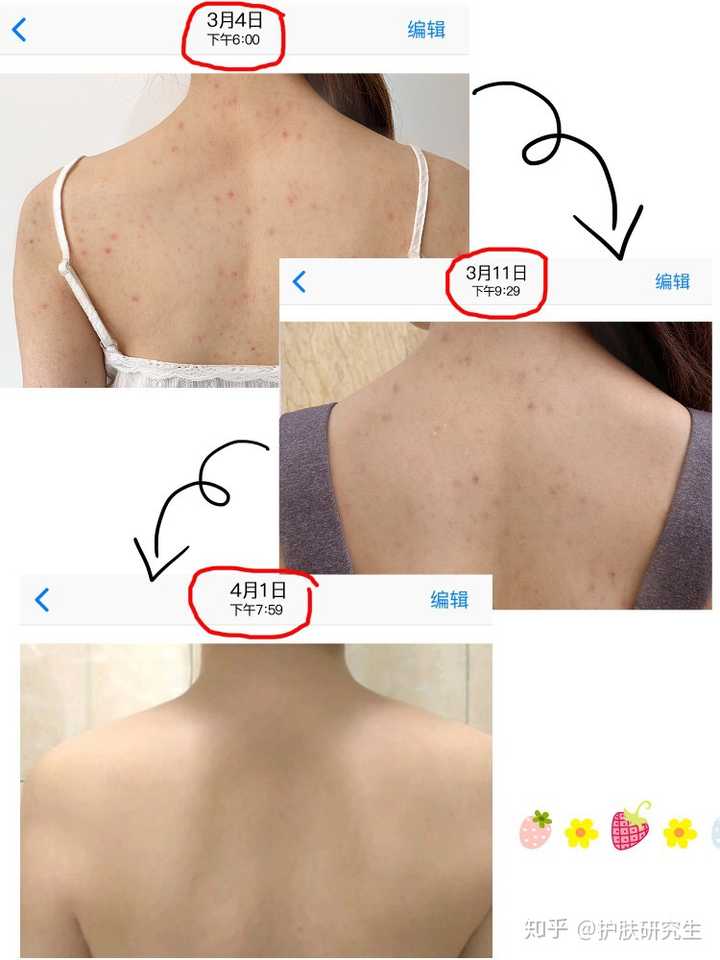 请问如何有效地祛除背后的痘痘和痘印?