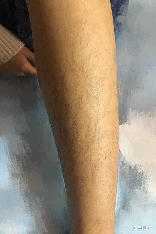 光子脱毛是永久吗去鸡皮肤(光子脱毛是永久吗去鸡皮肤有效果吗) 光子脱毛是永久吗去鸡皮肤(光子脱毛是永久吗去鸡皮肤有效果吗)