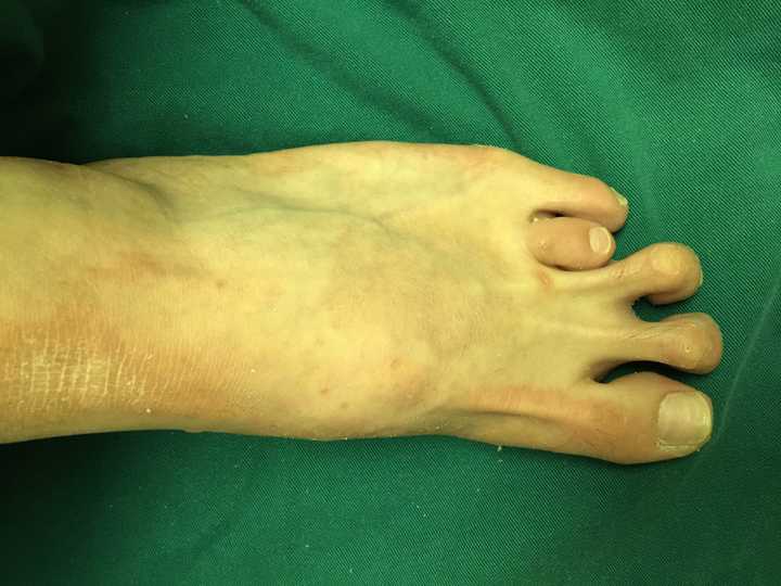短跖畸形(brachymetatarsia)是指跖骨过于短缩的一种畸形,常见于先天