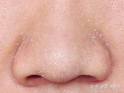 黑头的初期,多为白头,是一颗一颗白色的油脂粒,在毛孔里清晰可见