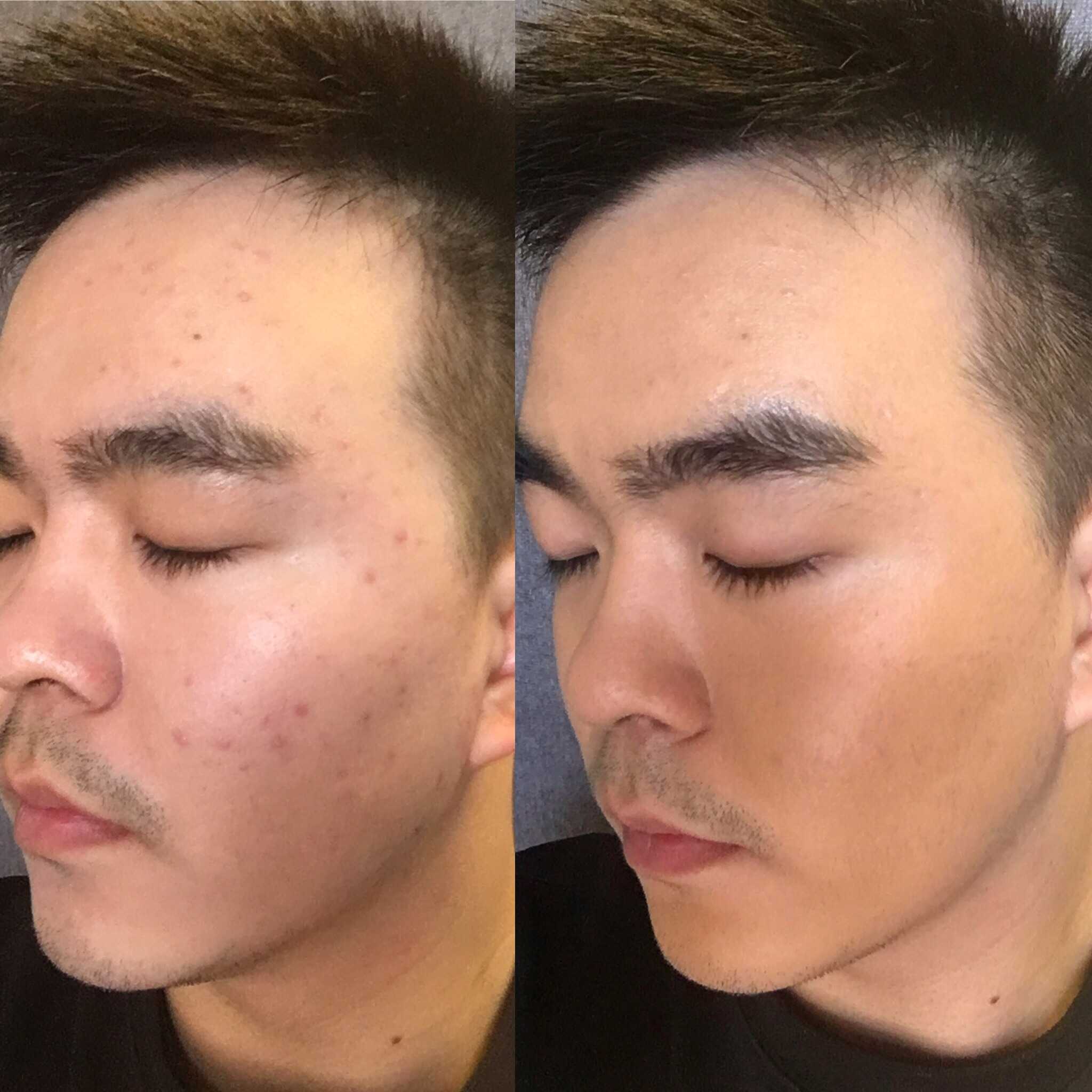 不多说 突然水土不服爆痘 日常盖痘印底妆 beforeafter 显示