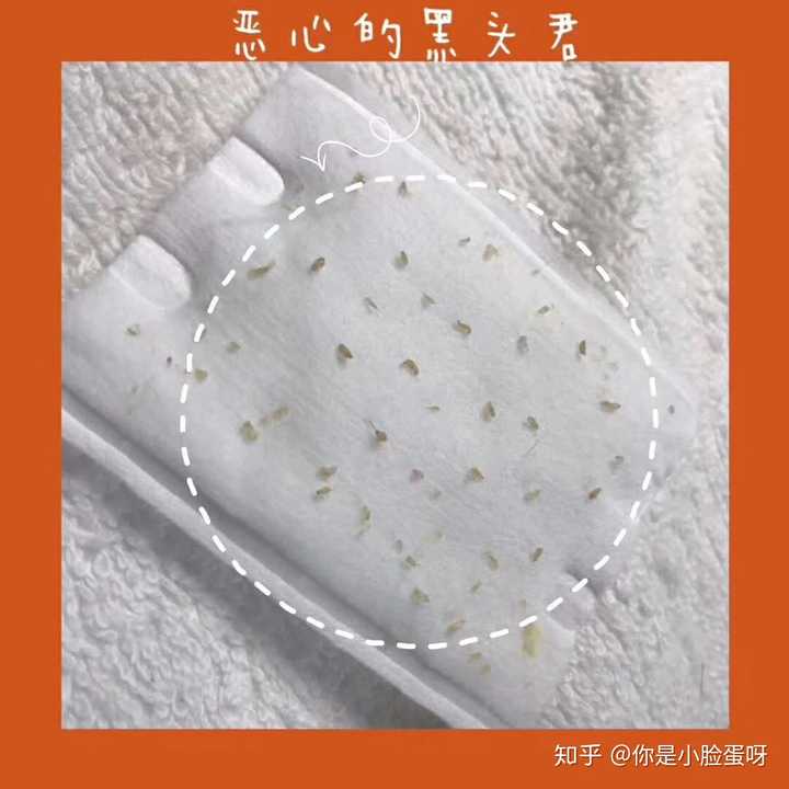 學生黨去除黑頭粉刺有什麼好方法?