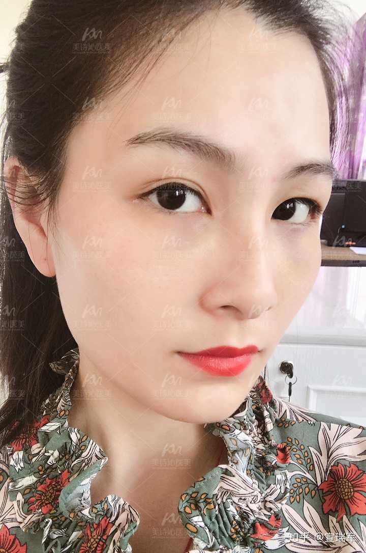 请问这种眼睛下面一条沟是眼袋77黑眼圈吗请问怎么办法可以修护