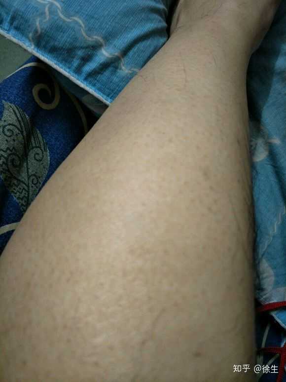 突然身上有鸡皮肤(为什么身上突然起鸡皮肤)