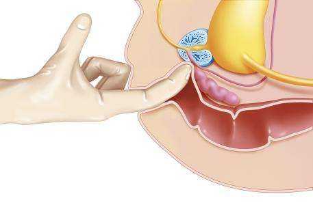 前列腺液怎么取出来图片