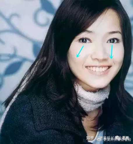 如何纠正斜视 知乎