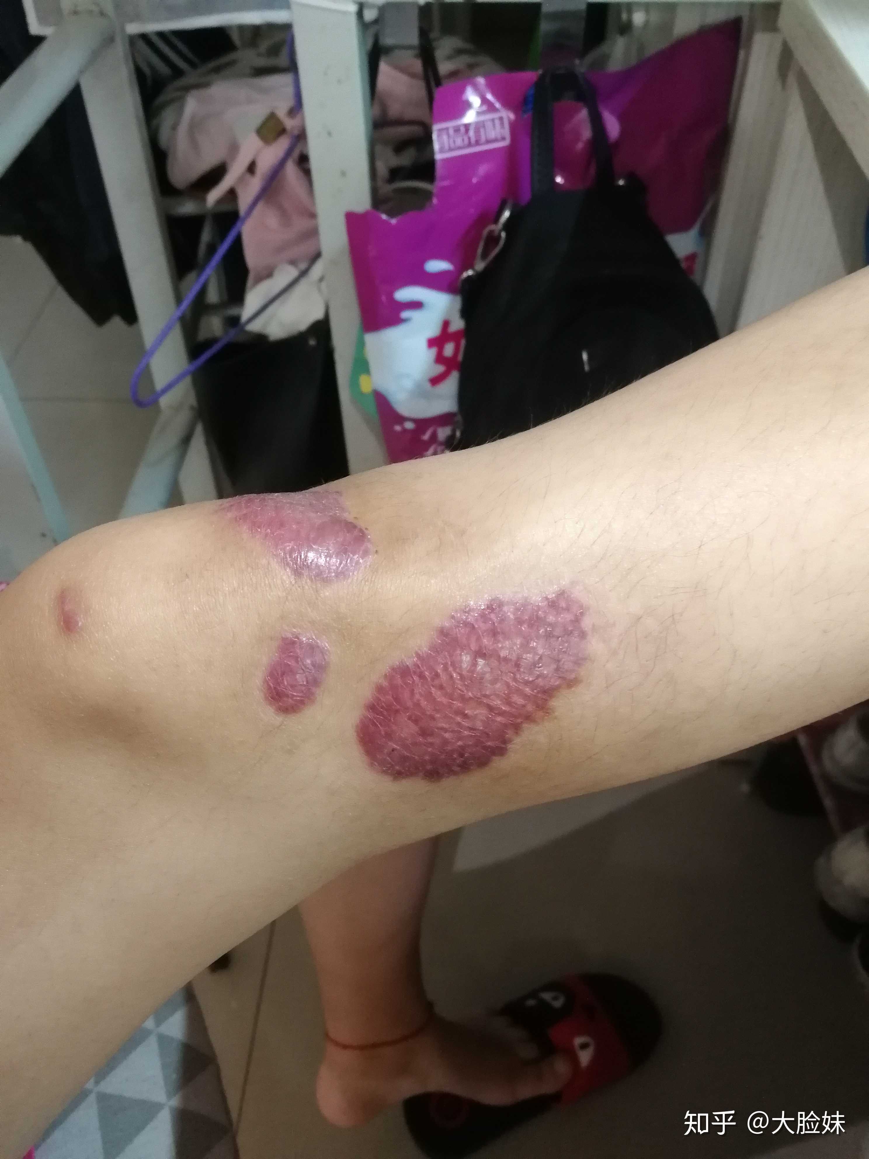 电动车跌伤,伤疤掉了之后就一直是这种状态,跪求医学大佬这种现象怎么