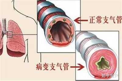 未来几年内哮喘能够根治吗? - 知乎