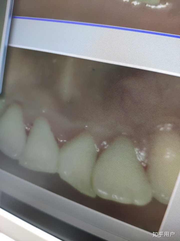 洗牙一般多少钱一次 知乎 洗牙一般多少钱一次 知乎