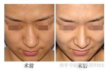 鼻骨歪斜如何矫正?