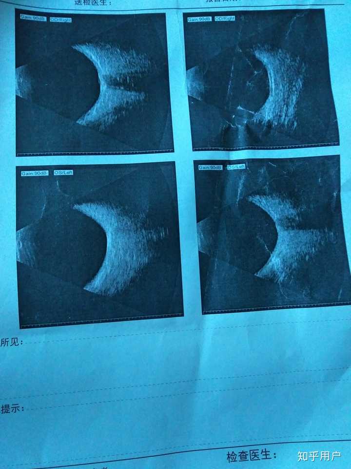 飞蚊症如何治疗那些药对飞蚊症有用还请那些治疗好的患者说说拜托了