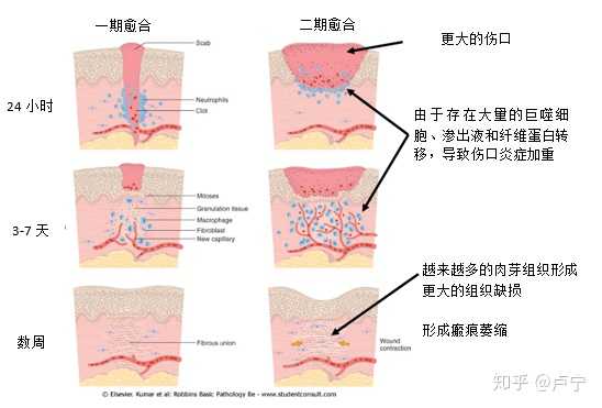 增生活动期 一般在伤口愈合后的6~12个月达到高峰,持续3-6个月,部分