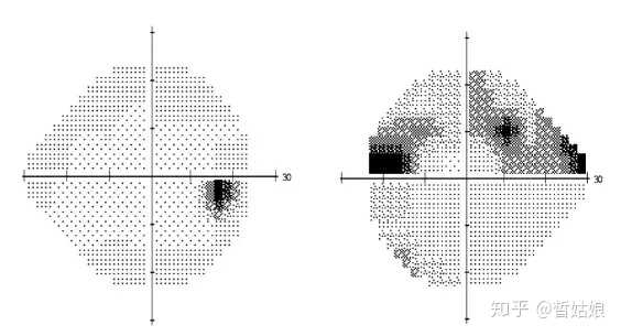 视力正常与早期青光眼患者的视野图
