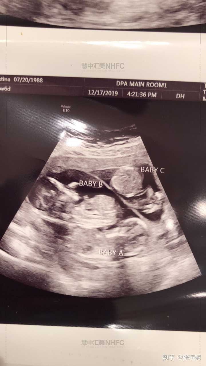 胎儿三个半月男孩图片图片
