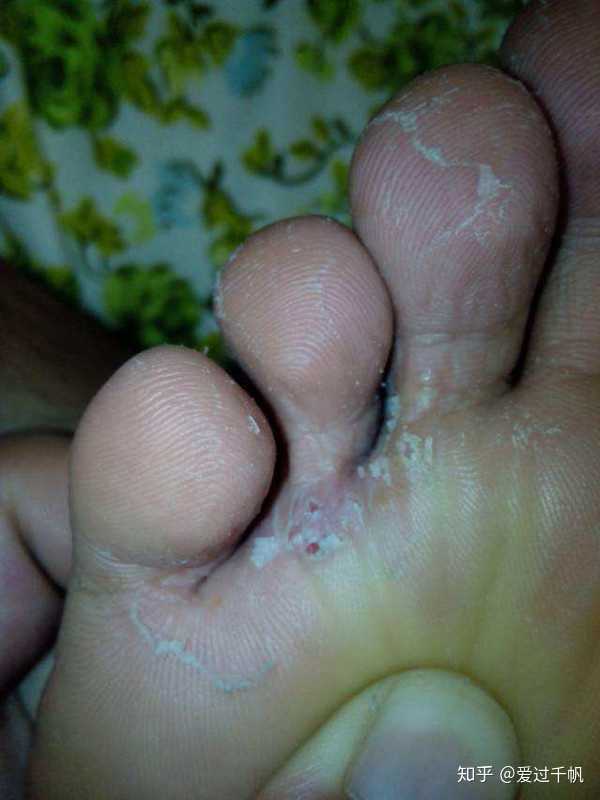 你是怎么治好脚气的?