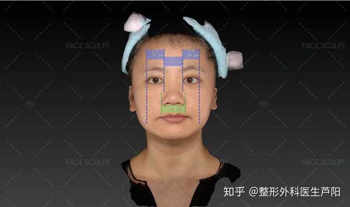 下颌缘轮廓针打的是肉毒素吗_下颌缘轮廓针和瘦脸针_下颌缘提升是轮廓针么