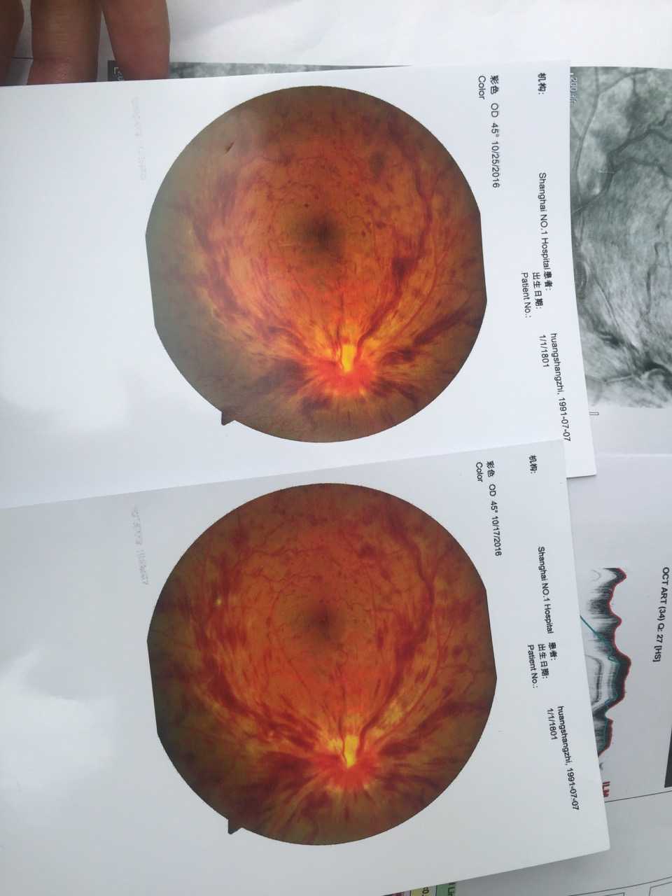 上个月查出来crvo,在上海第一人民医院诊断说是视盘血管炎导致的