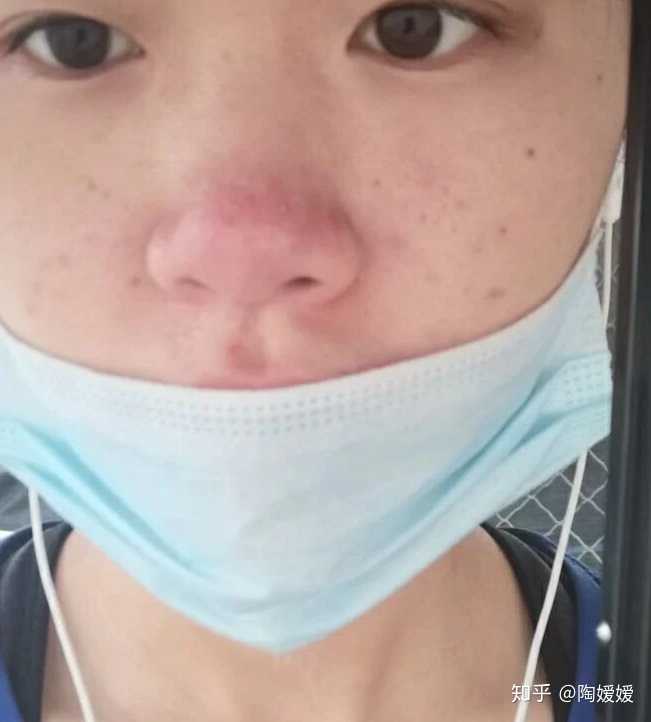 鼻子两侧长期发红，偶见长痘，有白色分泌物，这是什么病？