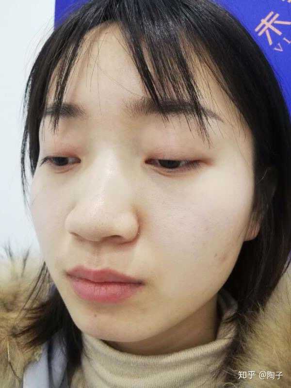 如果年纪大了会不会看起来断层,会让鼻梁变低吗?