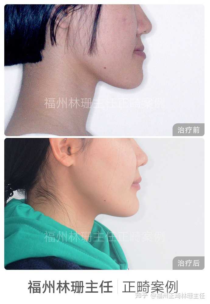 牙齿地包天(兜齿)是怎样的一种体验?