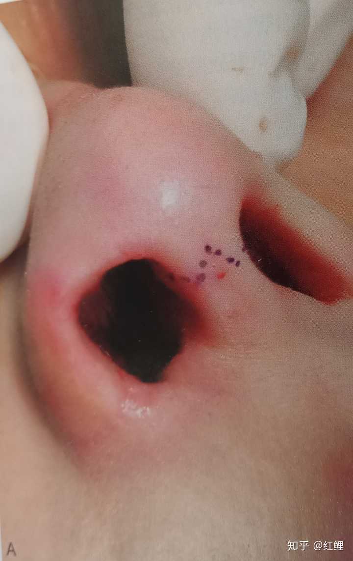 此为鼻小柱切口