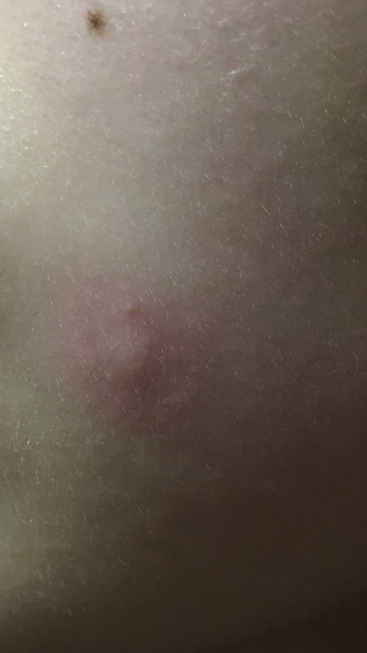 脸上会无故冒出一些像被蚊子咬的包,很痒,什么原因?