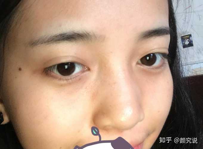 一点鼻梁都没有怎么办?