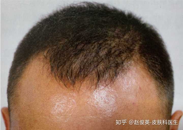 雄激素性脱发 知乎