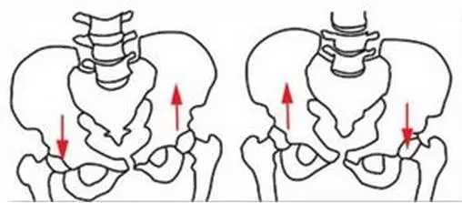 从正面观测时,左右髂嵴的高度不平衡,这就会使得一侧骨盆升