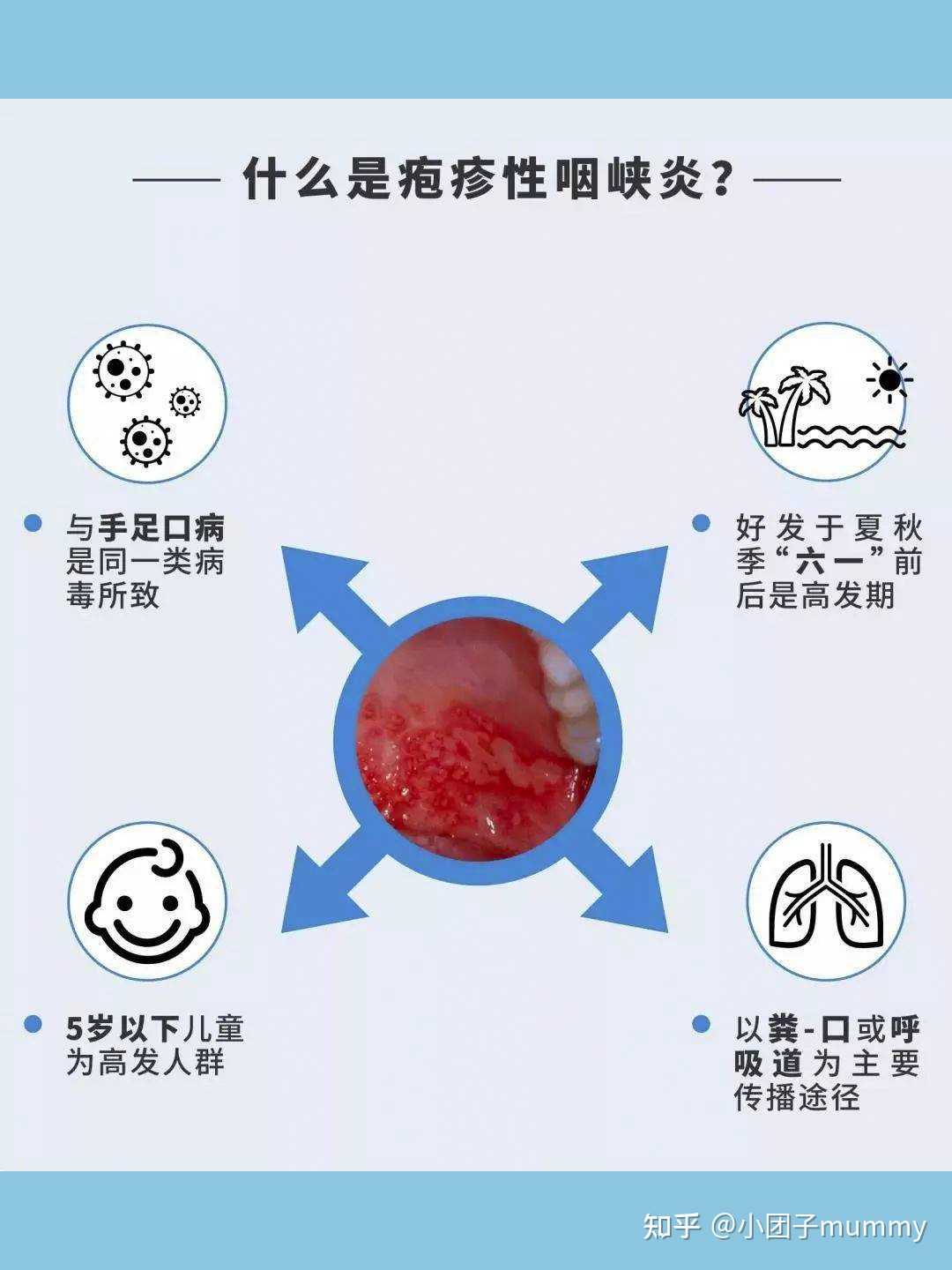 疱疹性咽峡炎 嗓子图片