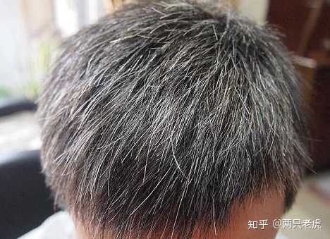 25岁女有白头发该不该拔了