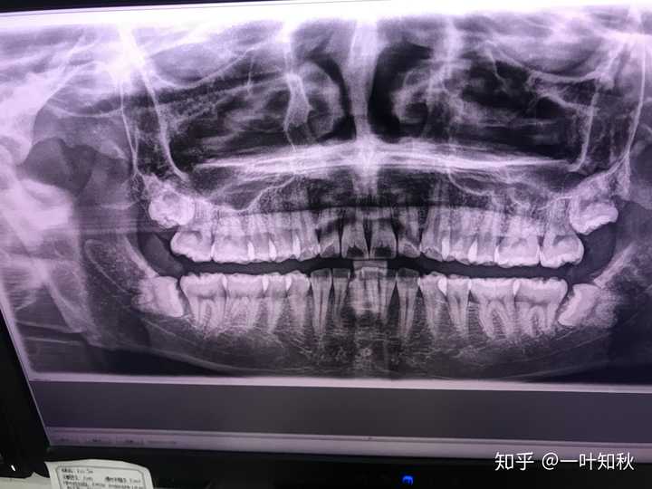 求问如图下边这两颗智齿,都是阻生齿,的拔牙难度?
