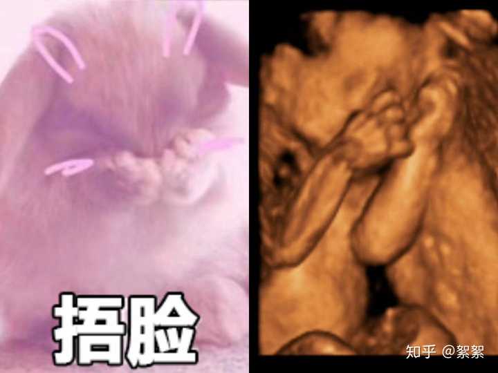 新生儿双性别的图片图片