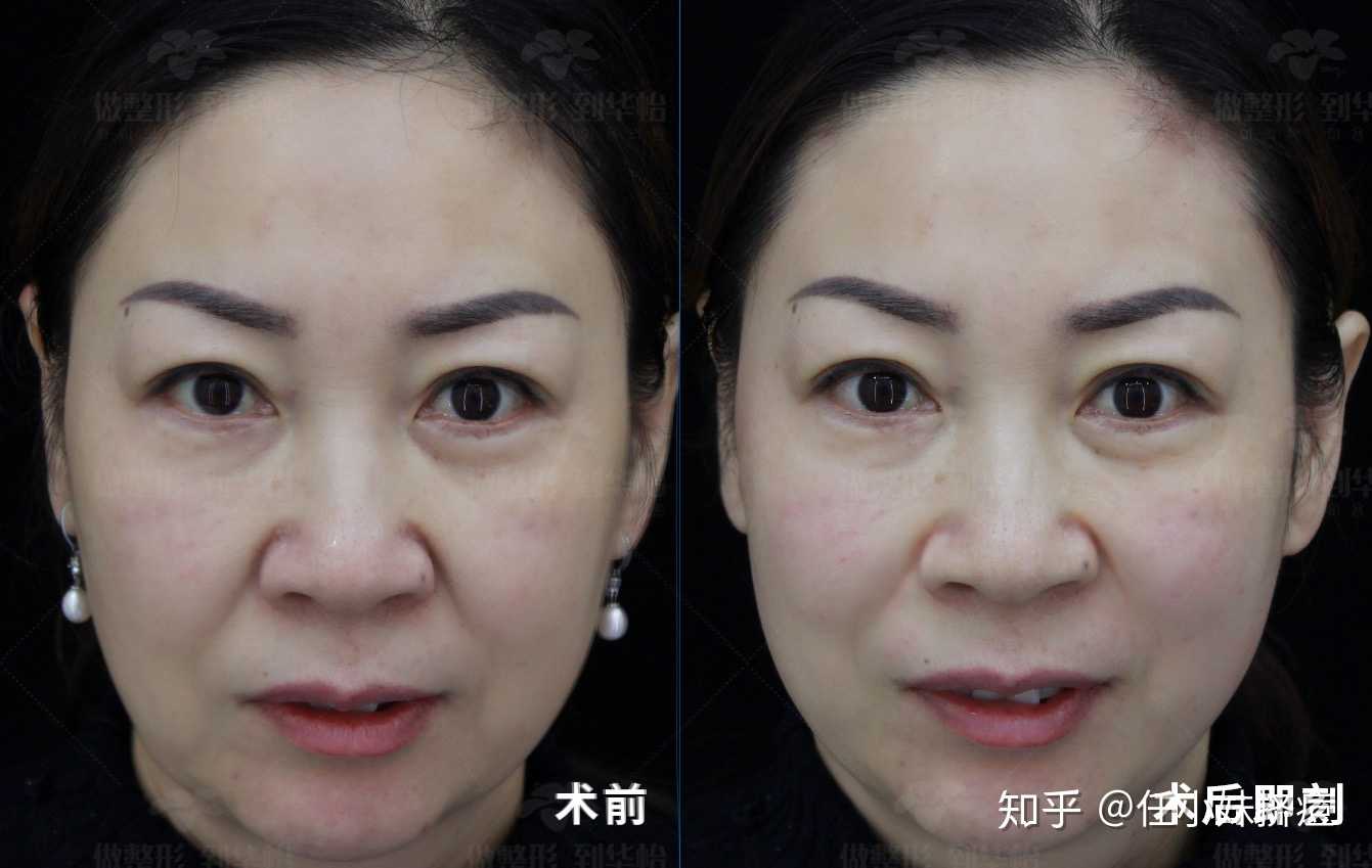 太阳u美极面部抗衰对比