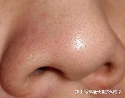 男士如何去黑头 知乎