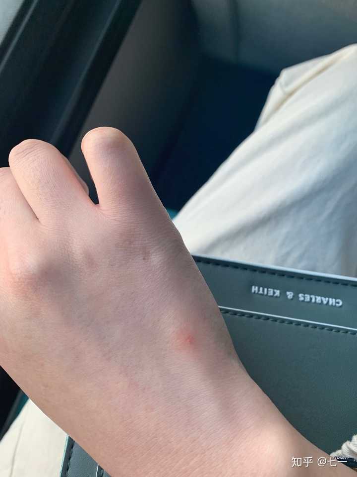 手上有红色的痣,不知道是什么痣?