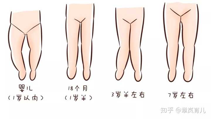 宝宝腿型发育如下: 1, 婴儿期(1岁内):腿是o型的,因为髋关节要发育,这