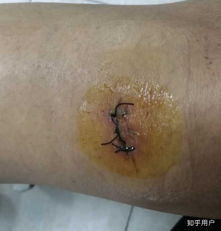 缝针和拆线可怕吗 疼吗 你们当时怕吗 知乎 缝针和拆线可怕吗 疼吗 你们当时怕吗 知乎