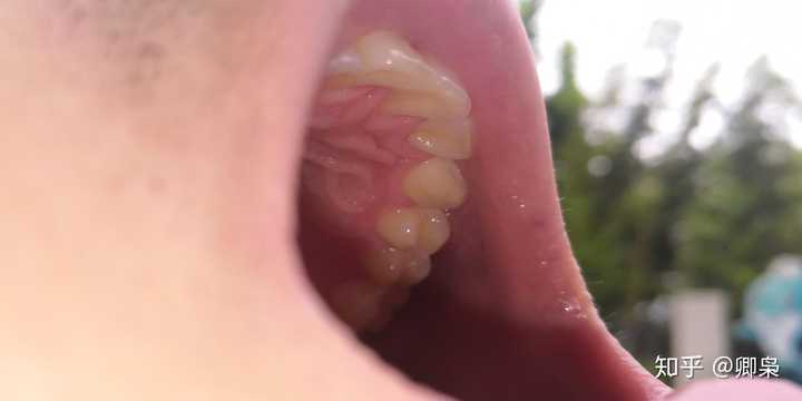 洗牙一般多少钱一次 知乎 洗牙一般多少钱一次 知乎