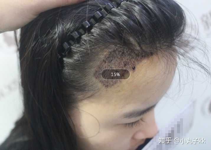 有没有已经在武汉植发的发友?