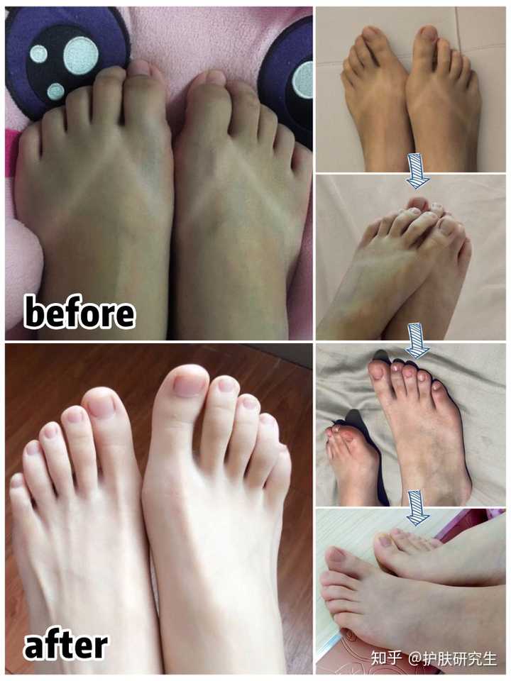 脚晒黑了怎么恢复 知乎