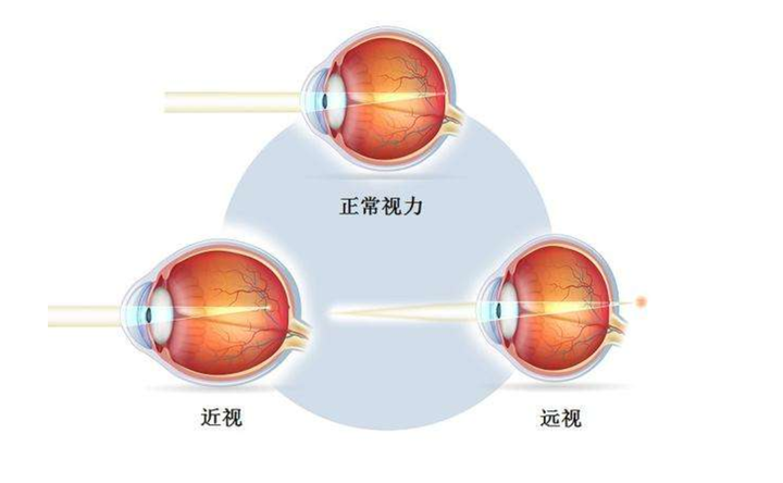 导致近视的原因有哪些？